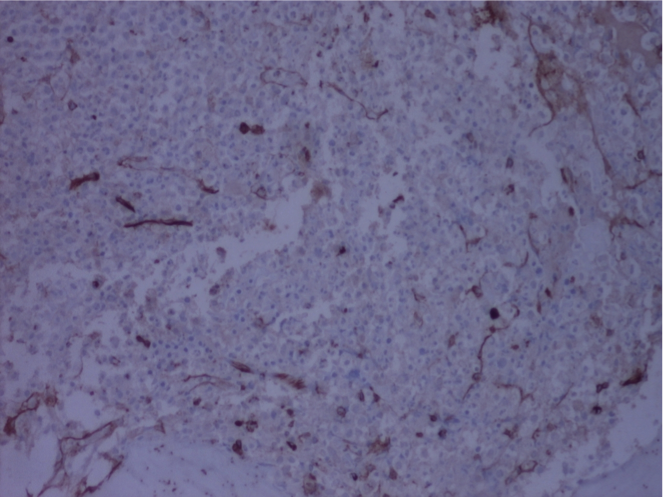 CD34 in Bone Marrow biopsy